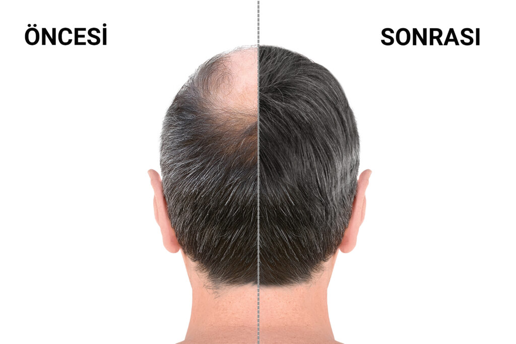 Alanya Protez Saç Merkezi